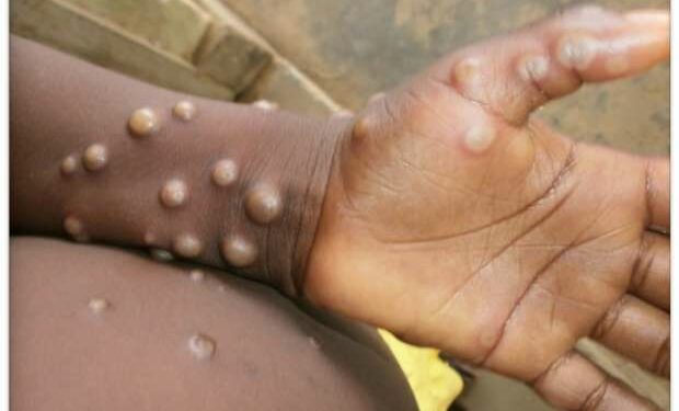 نظرة فاحصة.. إلى أي مدى يجب أن نقلق من جدرى القرود؟