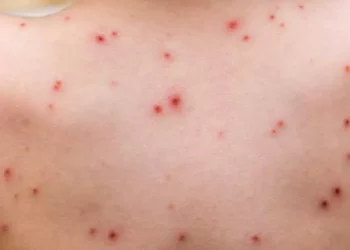 أسئلة غامضة ما زالت تحيط بجدري القردة