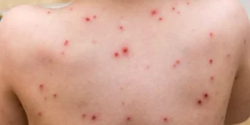 أسئلة غامضة ما زالت تحيط بجدري القردة