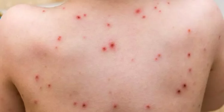 أسئلة غامضة ما زالت تحيط بجدري القردة