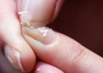 ما هي علامات وأعراض نقص الكالسيوم في الجسم؟