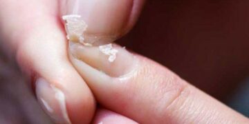 ما هي علامات وأعراض نقص الكالسيوم في الجسم؟