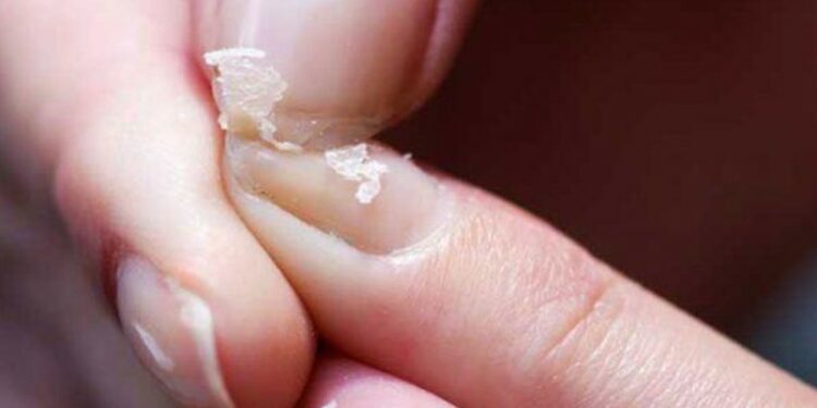 ما هي علامات وأعراض نقص الكالسيوم في الجسم؟