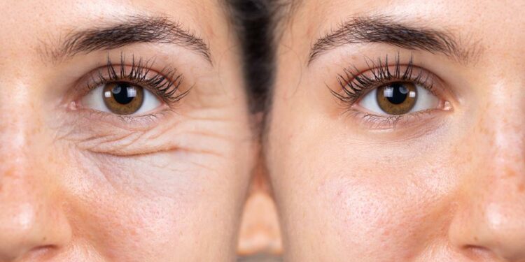 ما يجب معرفته حول شد الجفون: الفرق بين الجراحة والإجراءات غير الجراحية