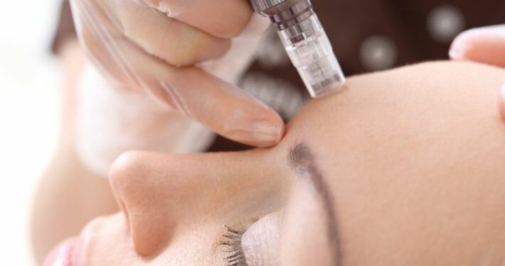 كل ما تحتاجين معرفته عن الميزوثيرابي لعلاج الذقن المزدوج