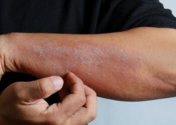 فوائد عسل النحل في علاج الإكزيما والعناية بالبشرة