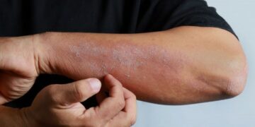 فوائد عسل النحل في علاج الإكزيما والعناية بالبشرة