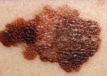 سرطان الجلد يختلف في مناطق الإصابة بين الرجال والنساء