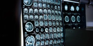 اختبار سريع يكشف مؤشرات الزهايمر قبل سنوات من التشخيص